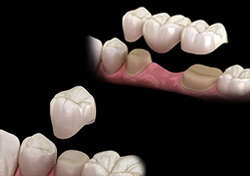 Dental Crown and Bridge