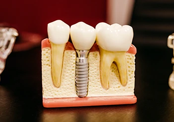 Dental Implants